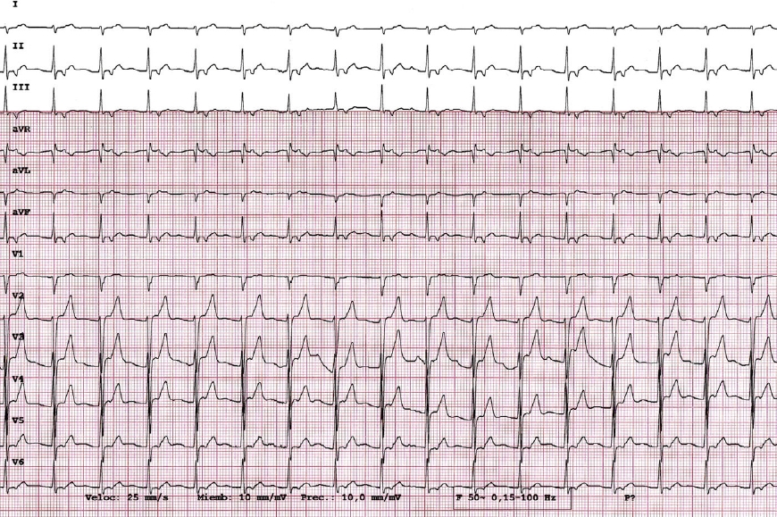 Ritmo Acelerado De La Unión Auriculoventricular