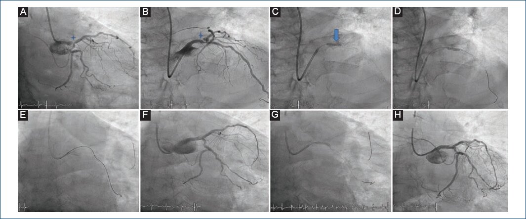 Revascularizaci N Del Tronco Coronario Distal Apoyada En Sistema De