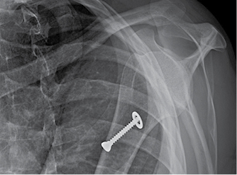 Técnica de Bristow Latarjet en la inestabilidad glenohumeral anterior