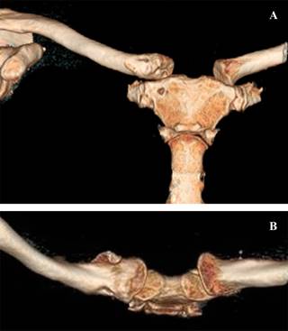 Luxaci N Esternoclavicular Anterior Descripci N De T Cnica Quir Rgica