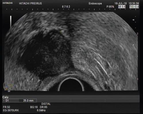 Schwannoma Differential Diagnosis Of A Subepithelial Gastric Lesion