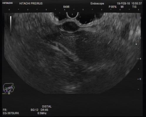 Schwannoma Differential Diagnosis Of A Subepithelial Gastric Lesion