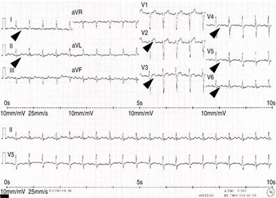 Wellens Syndrome Report And Review Of A Case