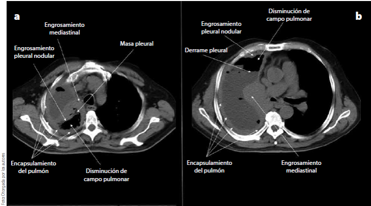 Mesotelioma Pleural Signos Y Sintomas Hot Sex Picture