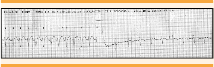 Cardioversión eléctrica de taquicardia ventricular en el embarazo