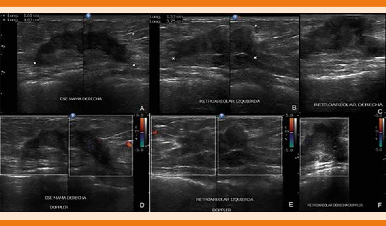 Ascitis Por Carcinoma Lobulillar Infiltrante Bilateral De Mama