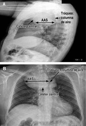 Sedoanalgesia Con Ketodex Para La Intubaci N Selectiva En La Resecci N