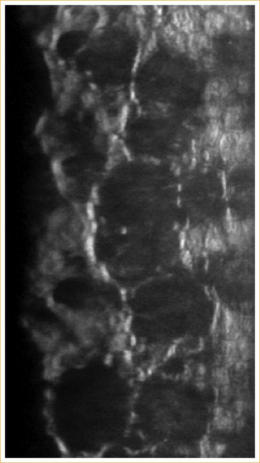 Resultado Visual Secundario A Recambio De Lente Intraocular Trifocal En