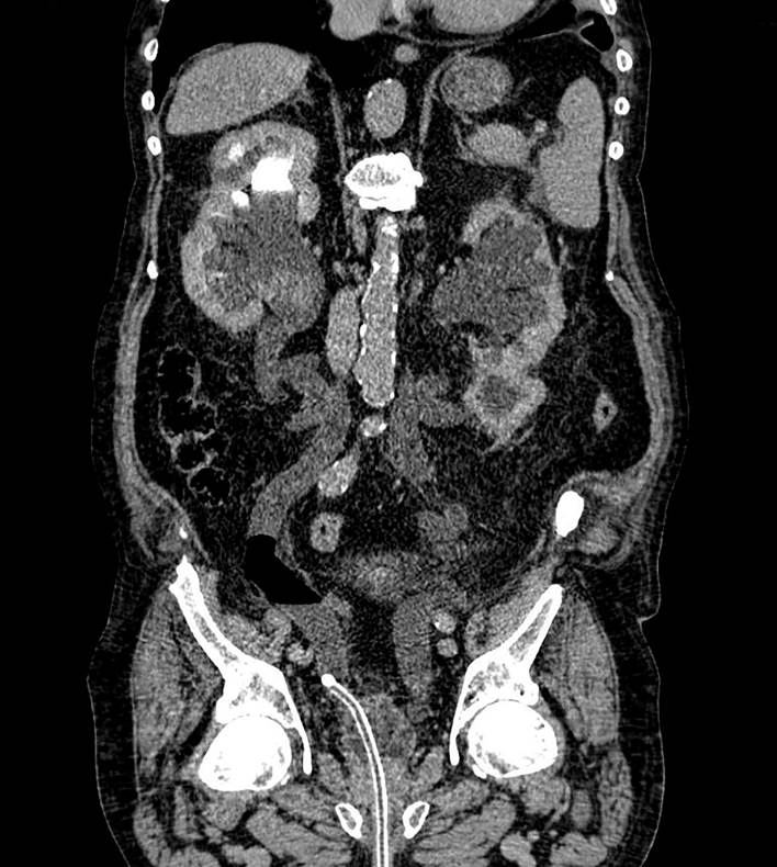 Inadvertent Urinary Catheter Placement In The Ureter: A Report On Two 