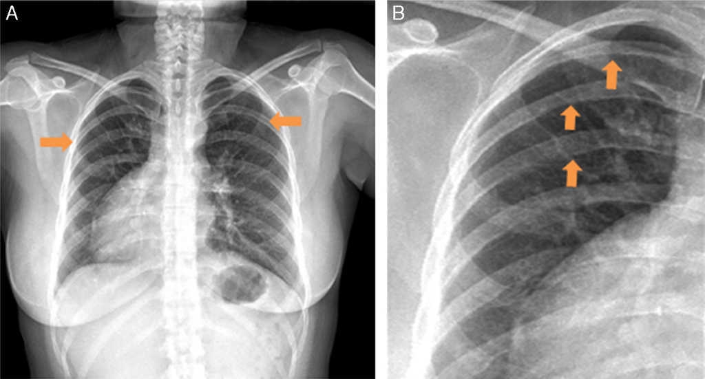 Dextrocardia, Coartación Aórtica Y Enfermedad Arterial Coronaria ...