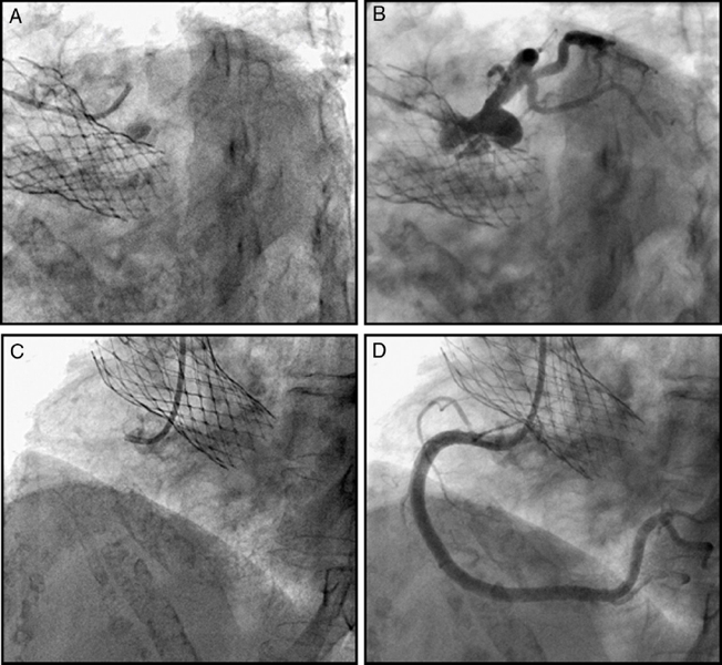 Coronary angiography in a patient with a previously implanted trans ...