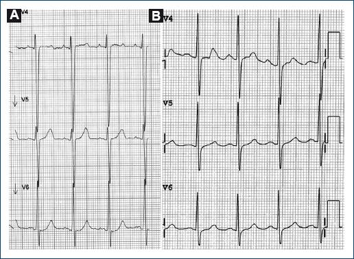 The volume and pressure overloads of the heart