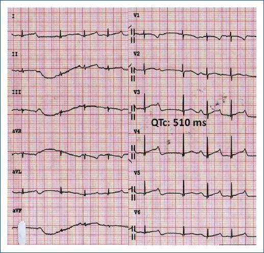 Long QT syndrome, utility of bicameral pacemaker