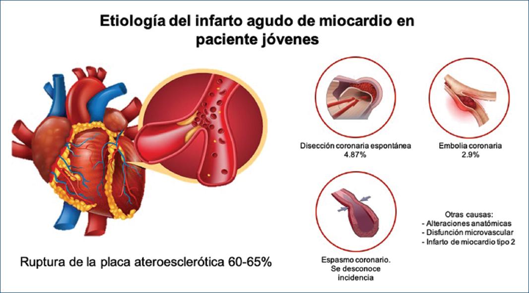 Infarto Agudo De Miocardio Revisión Sobre Factores De Riesgo