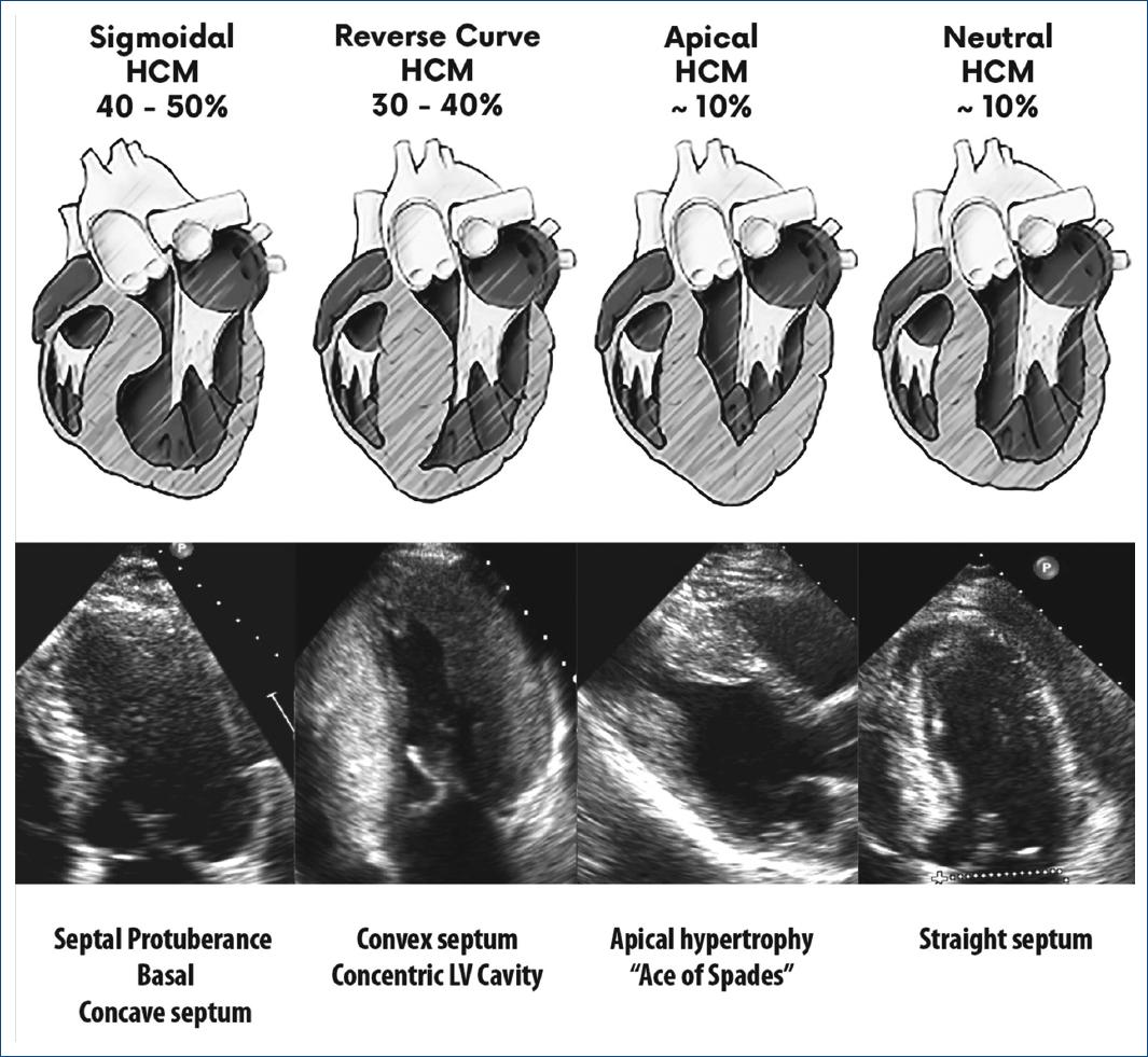 Hypertrophic Cardiomyopathy. Proposal For A New Classification