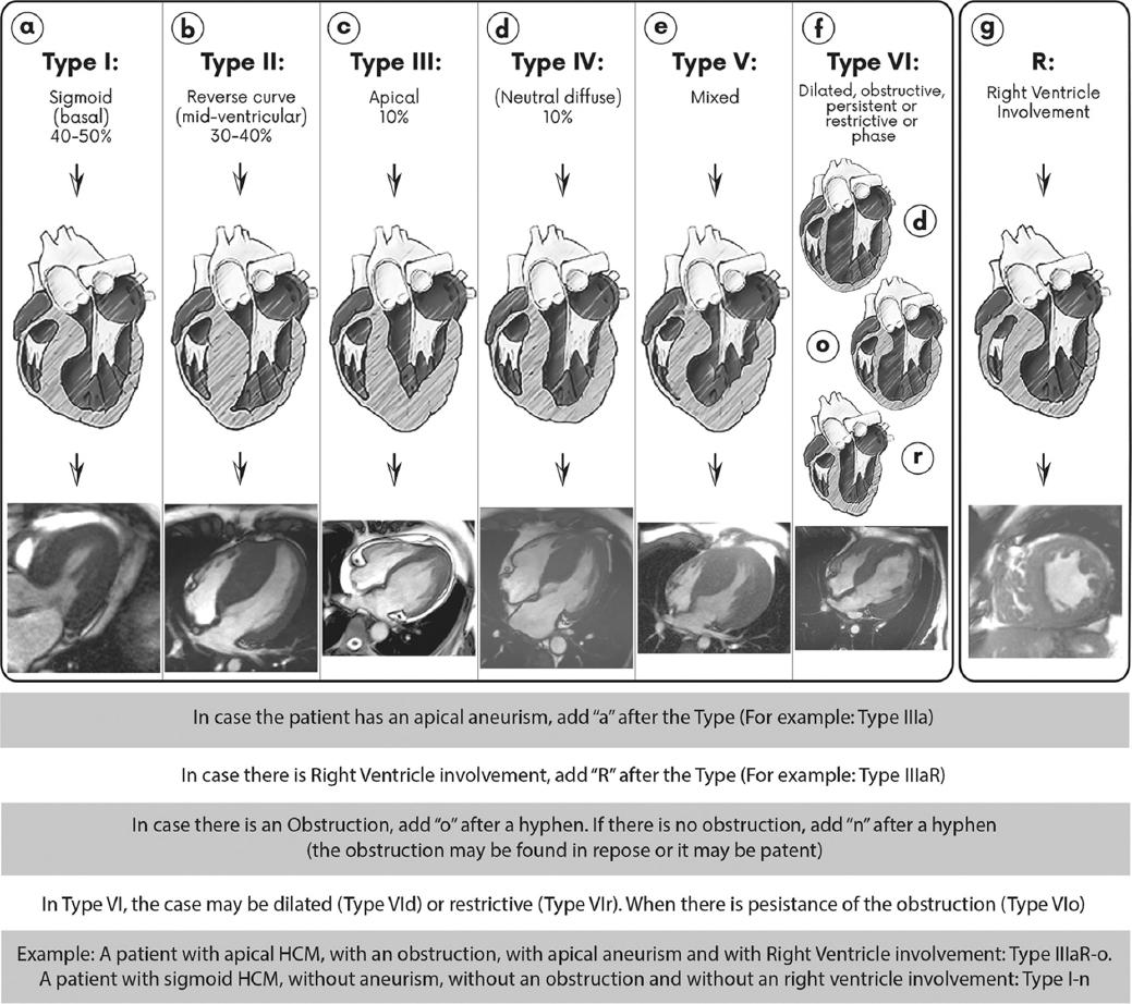 Hypertrophic Cardiomyopathy Proposal For A New Classification Hot Sex