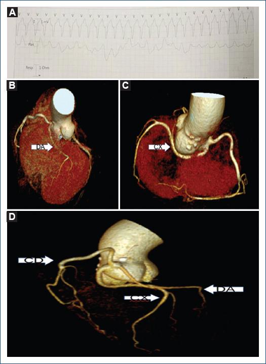 Una Anomalía Coronaria Poco Común Como Posible Causa De Taquicardia ...