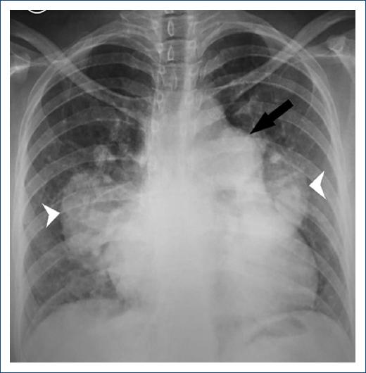 Severe arterial pulmonary hypertension in a 34-year-old patient