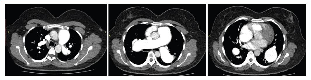 Severe Arterial Pulmonary Hypertension In A 34-year-old Patient