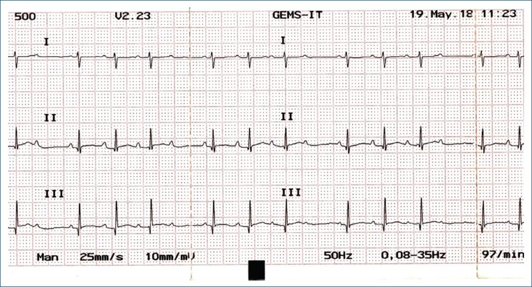 Transient type I 2nd-degree congenital atrioventricular block: a case ...