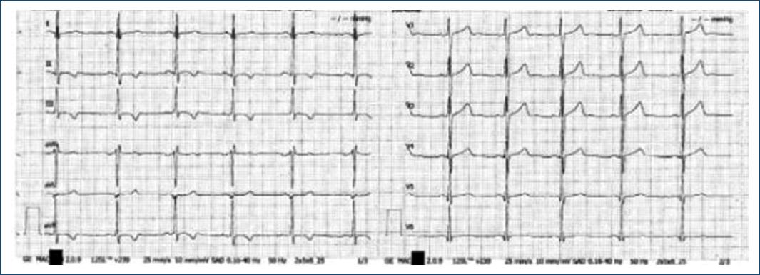 t-wave-inversion-in-young-athletes-normal-or-pathological