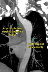 Divert Culo De Kommerell En Un Paciente Con S Ndrome Coronario Agudo