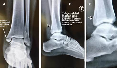 Fractura Del Mal Olo Tibial Asociada Con Una Luxaci N De Tendones De La