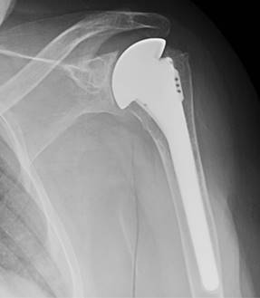 Resultados del tratamiento de la artrosis glenohumeral primaria ...