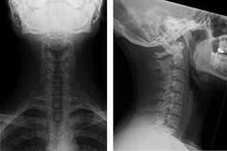 Cervical arthroplasty in a professional kick-boxing fighter, 7 years ...