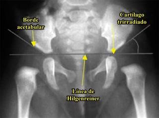 Aplicaci N Del M Todo De Graf Para El Diagn Stico Y Tratamiento Oportuno De Displasia De Cadera