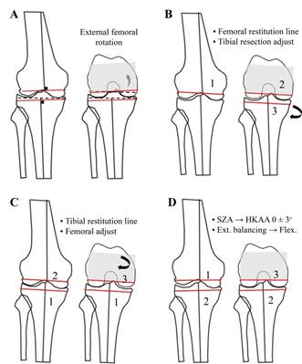 How common is extra-articular knee deformity? How to achieve a «safe ...