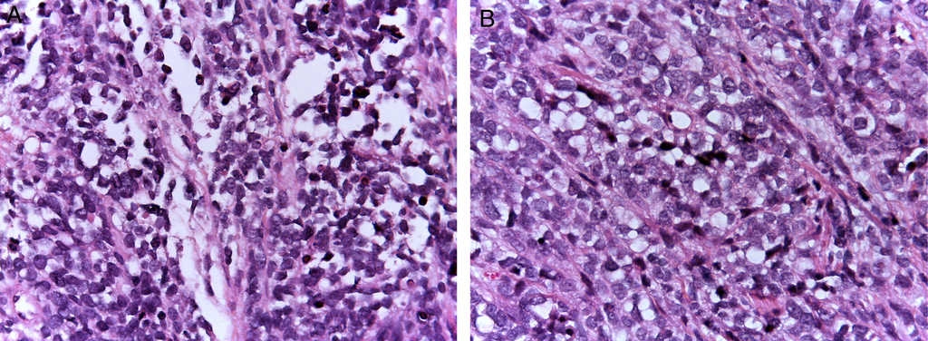 Alveolar rhabdomyosarcoma: origin and prognostic implications of