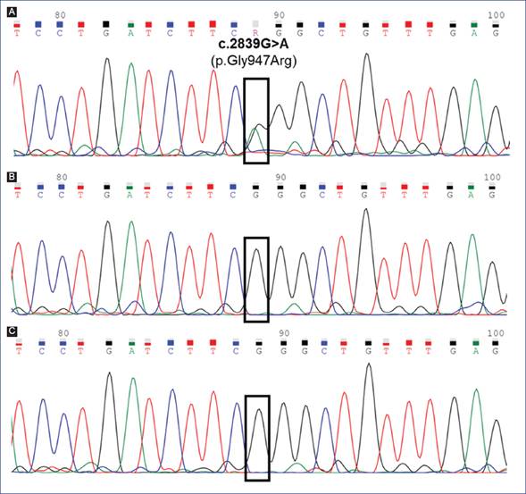 A recurrent de novo mutation in ATP1A3 gene in a Mexican patient with ...