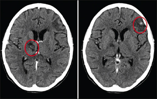 Hyperferritinemic sepsis secondary to invasive Toxoplasma gondii in a ...