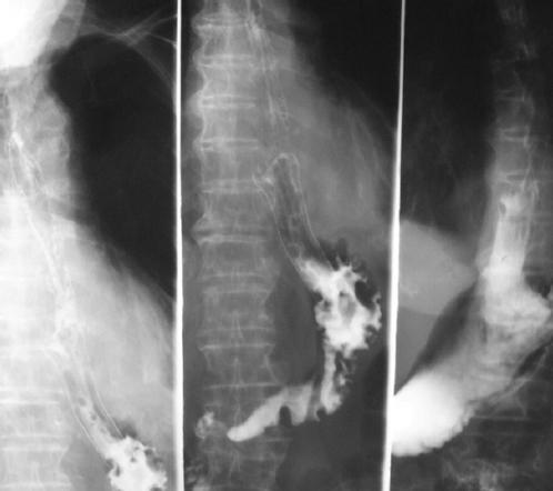 Conservative treatment of Boerhaave’s syndrome in an octogenarian ...