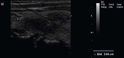 Primary thyroid tuberculosis: a case report