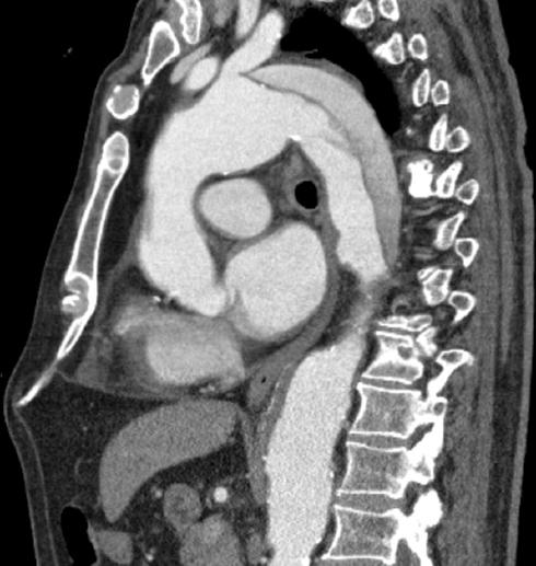 The revascularization of the left subclavian artery with a cross over ...