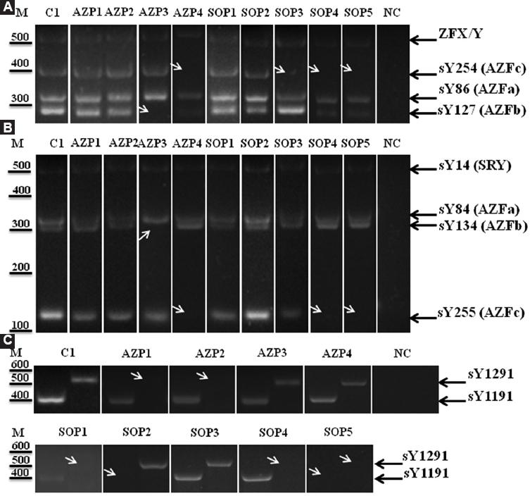 AZFa, AZFb, AZFc and gr/gr Ychromosome microdeletions in azoospermic