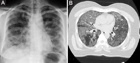 A case of pulmonary alveolar proteinosis misdiagnosed as COVID-19 pneumonia