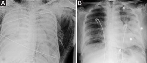 A case of pulmonary alveolar proteinosis misdiagnosed as COVID-19 pneumonia