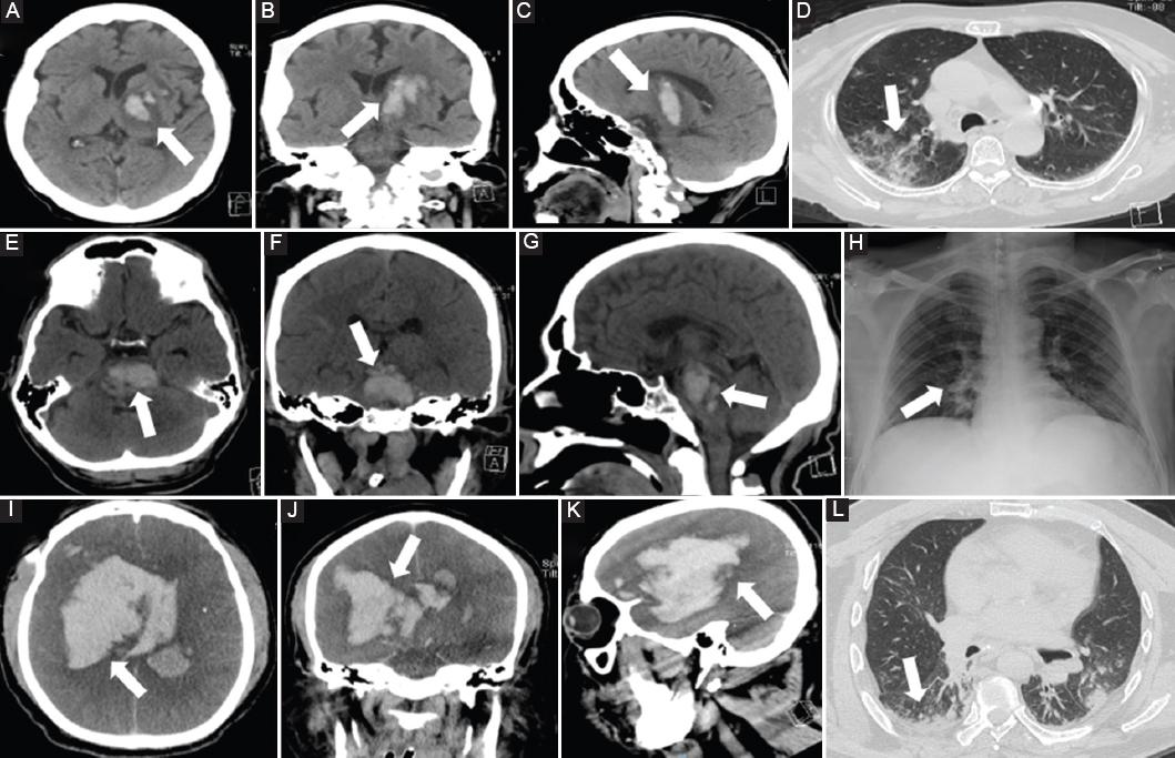 Primary spontaneous intracerebral hemorrhage in COVID-19 patients ...