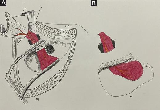 Vertical musculocutaneous trapezius flap for the closure of ...