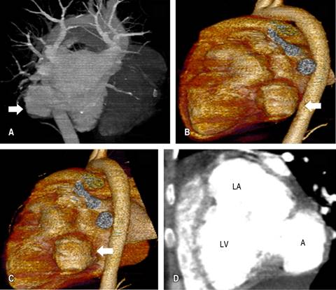 Submitral aneurysm as a cause of mitral valve insufficiency