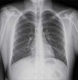 Clinical case of Cor triatriatum in a patient with CHA2DS2VASc 1-point ...