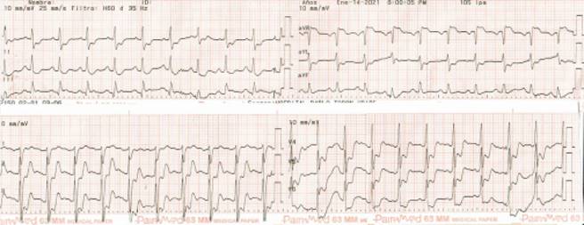 Spontaneous coronary artery dissection associated with exercise as a ...