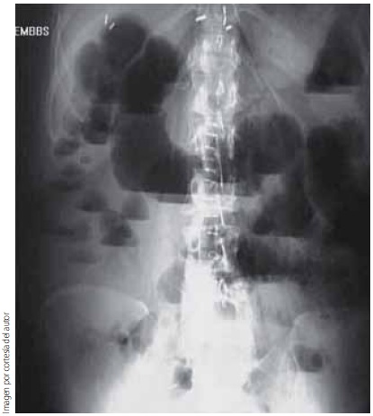 Radiografía simple de abdomen de pie y decúbito con evidencia de