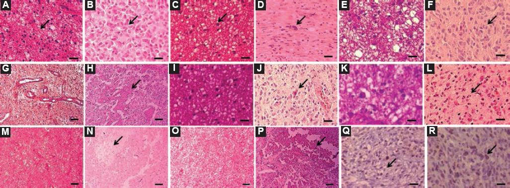 Semi-quantitative Evaluation Of Brain Gliomas In Adults: A Focus On 