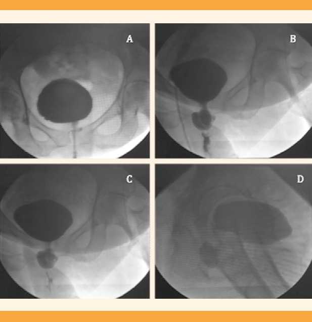 Female Urethral Diverticulum: Diagnosis, Treatment and Outcome