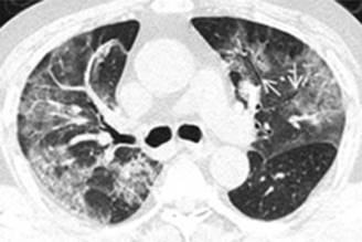 Protocolo De Manejo Para La Infección Por COVID-19