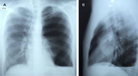 Spontaneous hemopneumothorax